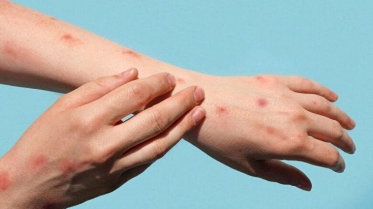 Rasti i parë me linë e majmunit në Shqipëri – Si përhapet dhe cilat janë simptomat
